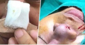 Spartaczona operacja nosa pozostawiła tę kobietę z silikonowym implantem wystającym między oczami