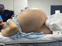 Wyglądała, jak w ciąży z dziesięcioraczkami. Lekarze nie mogli uwierzyć, co kryło się w środku jej brzucha